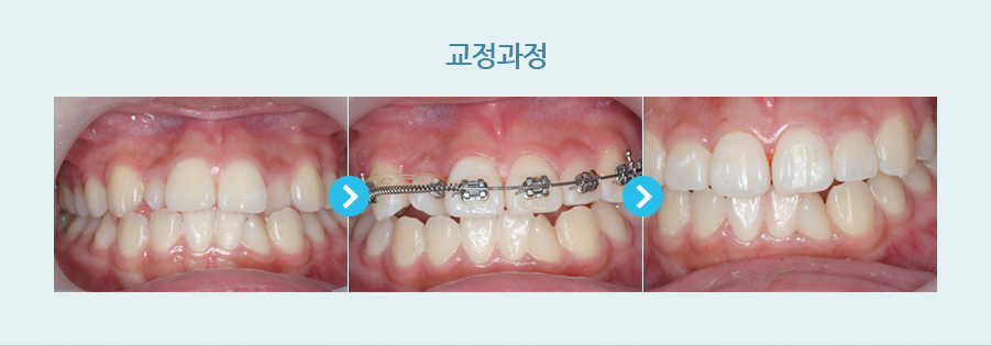 교정과정